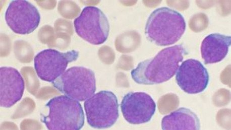 ¿La panacea contra el cáncer? Científicos afirman que la leucemia puede devorarse