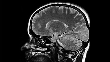Operan a una mujer para extirparle un tumor del cerebro y descubren que es un embrión