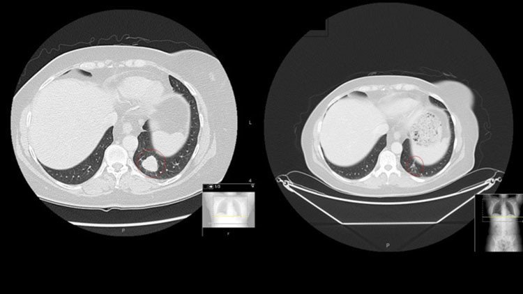 Presentan un revolucionario tratamiento biotecnológico contra varios tipos de cáncer