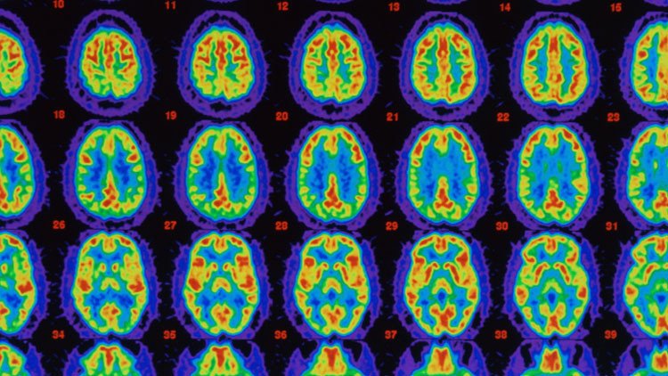 Desarrollan el primer medicamento que puede frenar el alzhéimer