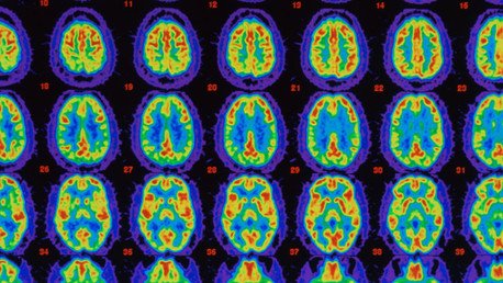 Desarrollan el primer medicamento que puede frenar el alzhéimer