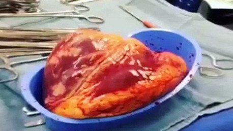 Impactante video: El corazón de un cocainómano late 25 minutos... ¡fuera del cuerpo!