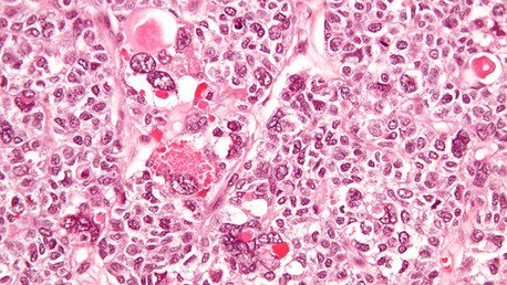 Científicos chilenos desarrollan una innovadora terapia contra el cáncer