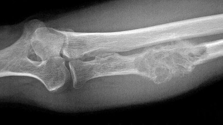 Médicos mexicanos crean un innovador tratamiento para el cáncer de hueso