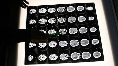 Las infecciones por hongos podrían estar relacionadas con la aparición de alzhéimer