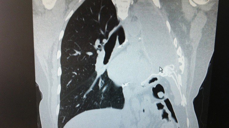 "Asesino invisible": un gas presente en muchos hogares podría causar cáncer de pulmón
