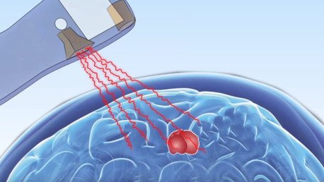 Dispositivo creado para detectar explosivos revela la existencia de tumores de forma remota