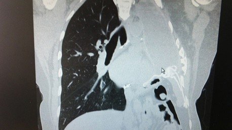 "Asesino invisible": un gas presente en muchos hogares podría causar cáncer de pulmón