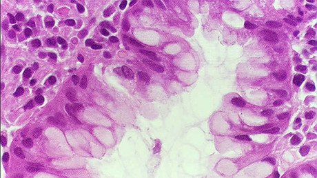 Una 'superbacteria' altamente mortífera se propaga velozmente por el mundo