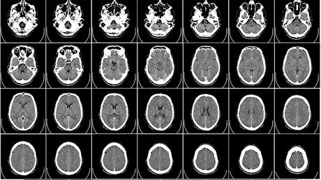 ¿Es el agua que bebe la causa directa de la aparición del alzhéimer?