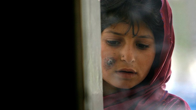 Una enfermedad preocupante se extiende desde Siria por Oriente Medio y ha llegado a Europa