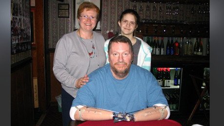 El primer estadounidense con las dos manos trasplantadas quiere deshacerse de ellas