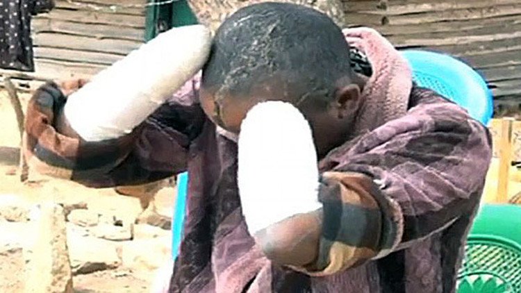 Un hombre destroza la cara de su mujer y le amputa las manos a machetazos por no tener hijos