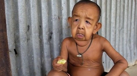 'Benjamin Button': La tragedia de un niño de 4 años que tiene aspecto de anciano