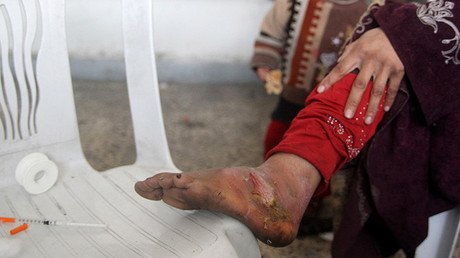 La 'enfermedad zombi' que azota Oriente Próximo cruza el Atlántico