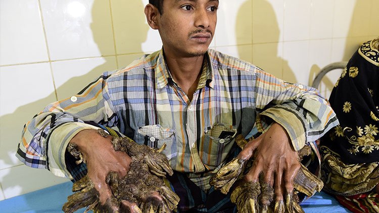 El "hombre árbol" de Bangladés por fin puede abrazar a su hija (FOTOS)