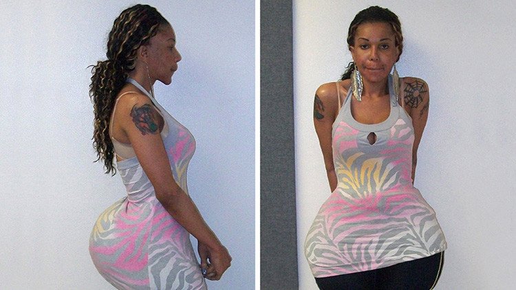 Condenan en EE.UU. a la pseudocirujana que inyectaba cemento y pegamento a sus pacientes 