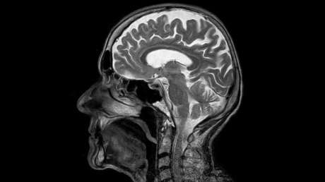 Descubren 13 errores genéticos que aumentan el riesgo de cáncer cerebral
