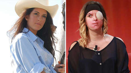 "No es amor": Una reina de belleza decide mostrar su rostro desfigurado tras ser rociada con ácido