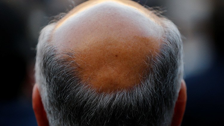"Prometedor": Científicos descubren un revolucionario método contra la calvicie