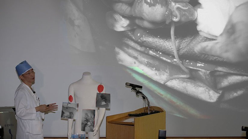 "Nunca he visto algo parecido": Extraen docenas de parásitos intestinales a un desertor norcoreano