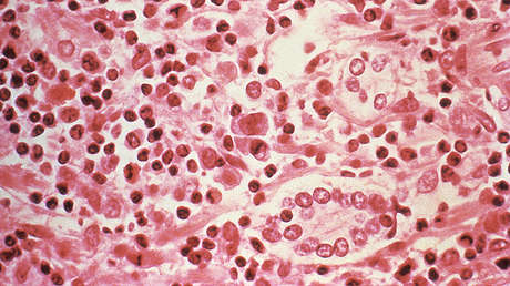 En este país latinoamericano un virus mortal ha aumentado su incidencia en un 81%