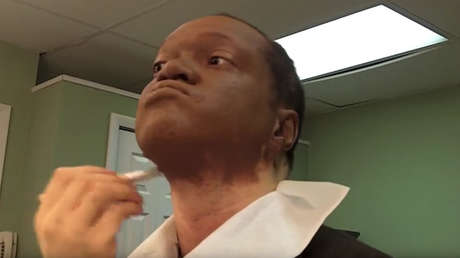 Este periodista ocultó una rara enfermedad de su piel por motivos laborales