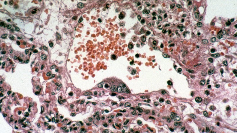Rebrota un virus mortal que no tiene cura y deja sus primeras víctimas 