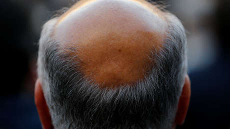 ¿La solución definitiva? Descubren un medicamento que podría tratar la calvicie