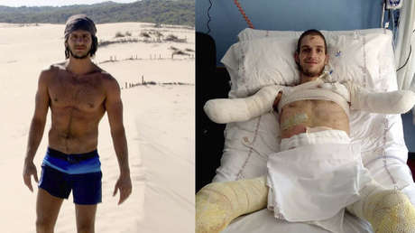 Amputan a un italiano los brazos y las piernas por un diagnóstico erróneo