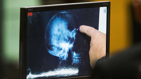 Científicos descubren canales secretos entre la médula ósea del cráneo y el cerebro