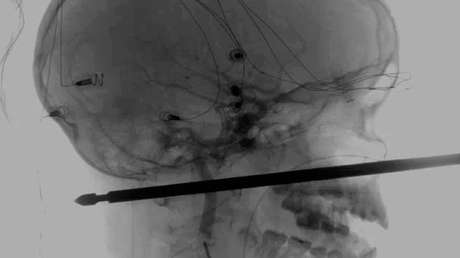 Un pincho para carne atraviesa la cabeza de un niño, pero sobrevive "milagrosamente"  