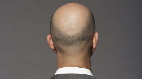 Descubren un nuevo método para revertir la calvicie