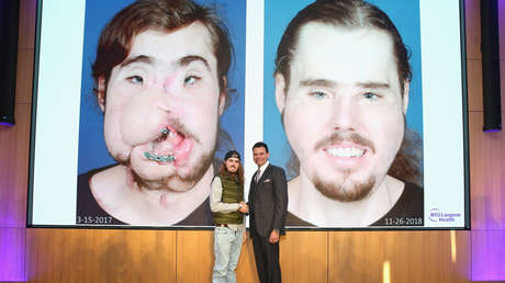 "Puedo sonreír de nuevo": Transplantan con éxito el rostro a un joven que intentó suicidarse (VIDEO)