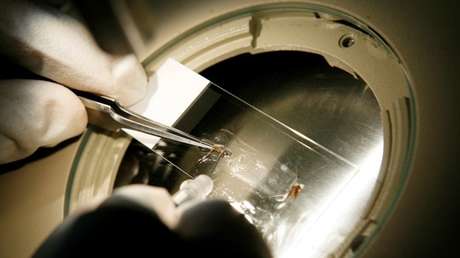 Mujer pierde un ojo por un parásito que pescó en la ducha y quedó bajo su lente de contacto (FOTO)