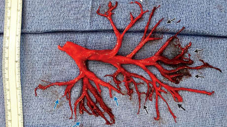 FOTO: Paciente desconcierta a los doctores al toser una parte del bronquio perfectamente conservada