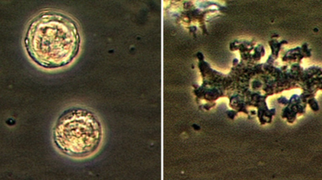 Una mujer muere por las amebas que le comieron el cerebro tras una irrigación nasal