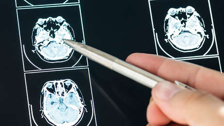 ¡Incluso surfea!: Nació con el 2% de su cerebro y en 6 años lo ha desarrollado hasta el 80%