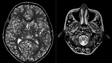 Acude al hospital con un fuerte dolor de cabeza y le hallan una plaga de larvas en el cerebro