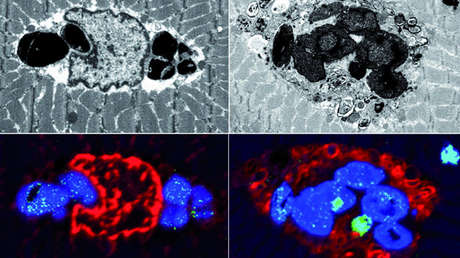 Descubren una nueva enfermedad en familias europeas que afecta a los músculos y de momento no tiene cura