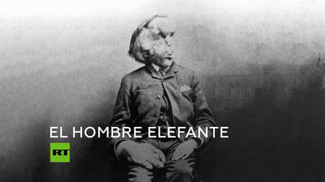 Joseph Merrick: Afamado por sus deformidades, amado por su humanidad
