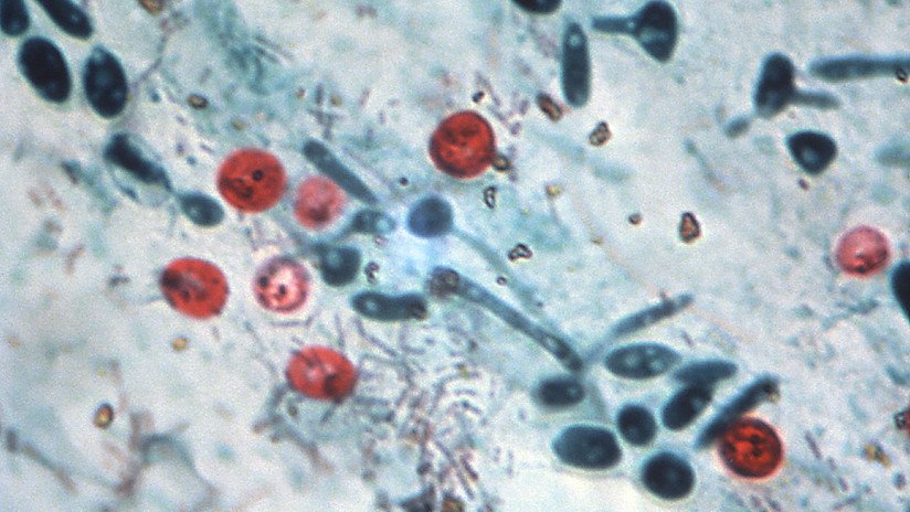 EE.UU.: Muere un paciente por un trasplante fecal que contenía una bacteria resistente a las drogas