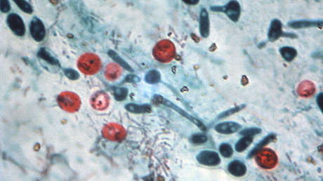 EE.UU.: Muere un paciente por un trasplante fecal que contenía una bacteria resistente a las drogas