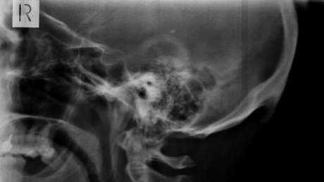 Alertan de que el uso de 'smartphones' está provocando el crecimiento de un 'cuerno' en el cráneo humano, ¿es cierto?