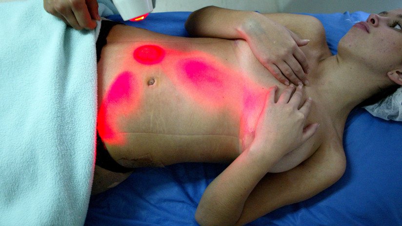 El mapamundi de la cirugía plástica: ¿Qué país de América Latina practica más liposucciones?