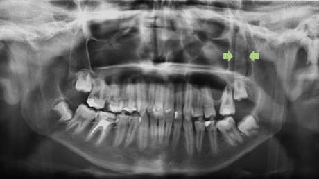Un chico español vivió un mes sin darse cuenta que llevaba un trozo de cristal incrustado en la cara