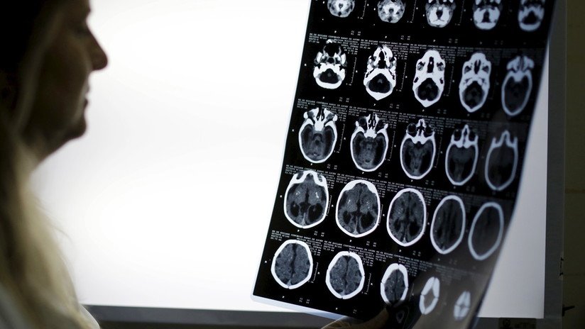 Una proteína del cerebro podría retrasar la progresión del alzhéimer