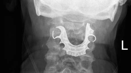 Un hombre de 72 años vive más de una semana con una dentadura postiza atorada en la garganta