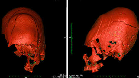 Explican el misterio de los cráneos alargados y oblicuos hallados en Croacia