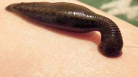 Extraen una sanguijuela viva de 8 centímetros de la garganta de un niño que tosió sangre por diez días